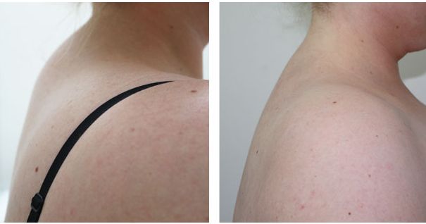 Вдовий горб до и после — результат работы с осанкой за 3 недели